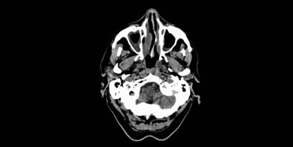 Cerebral pixel settlement Cerebral pixel settlement